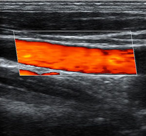 Triplex mode color doppler ultrasound